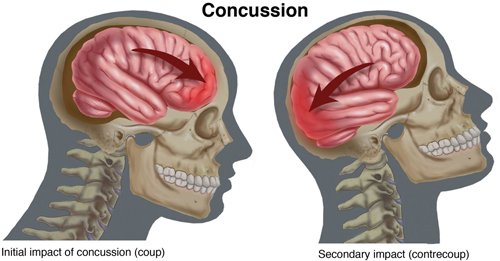 HBOT for Concussion in Dallas Metro Area